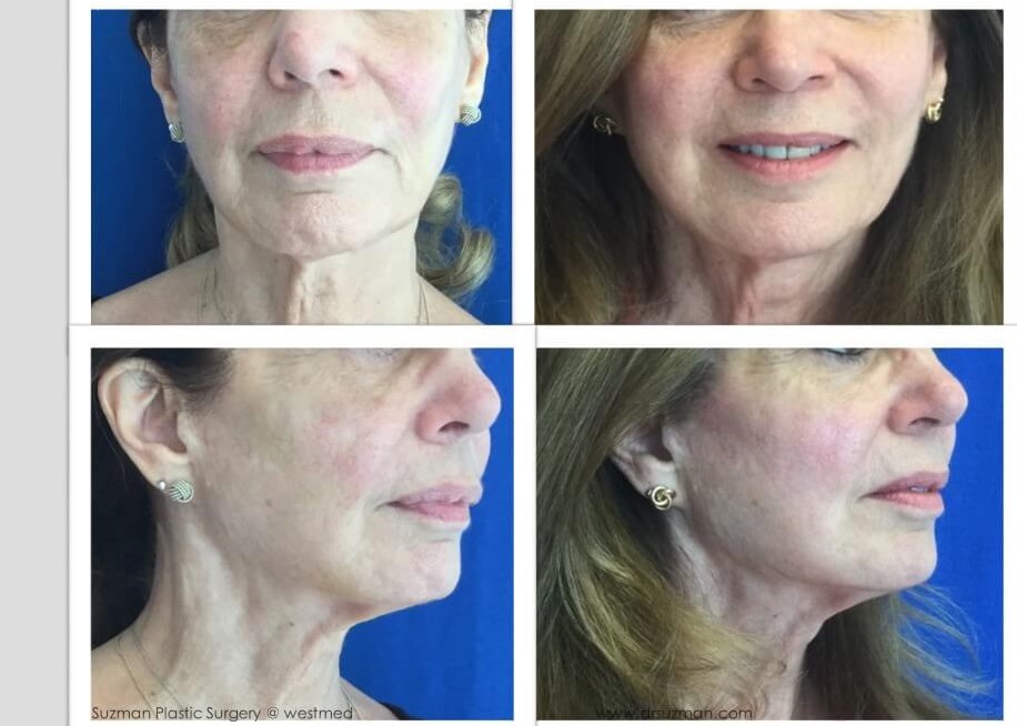 Dr. Suzman Fat Graft Procedure